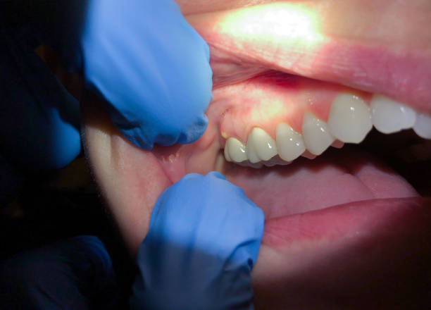 Best Emergency Dental Care for Abscessed Tooth in Waskom, TX
